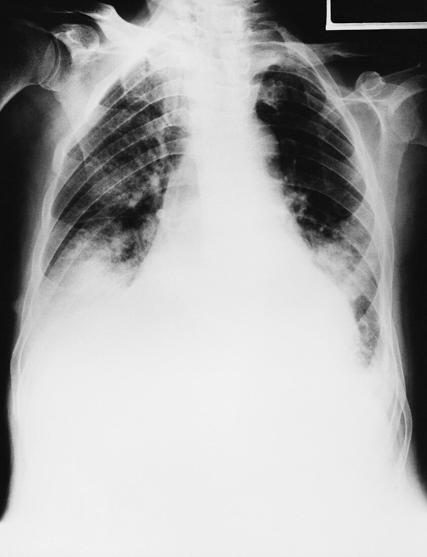 Pulmonary Edema