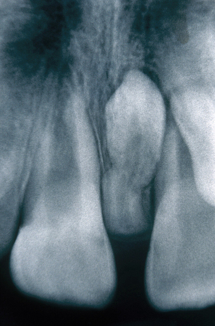 Supernumerary Tooth,X-ray
