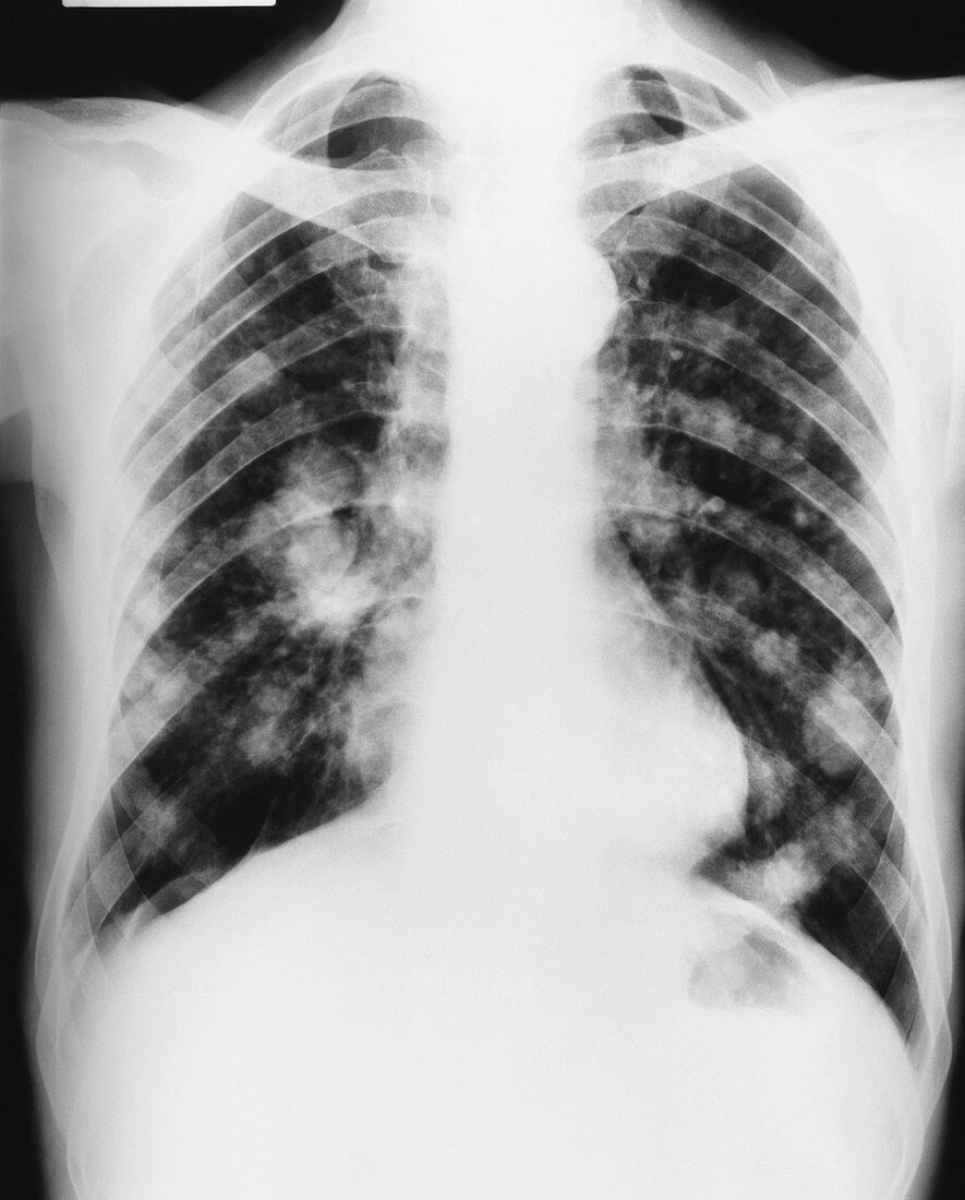 Metastasized Esophageal Cancer