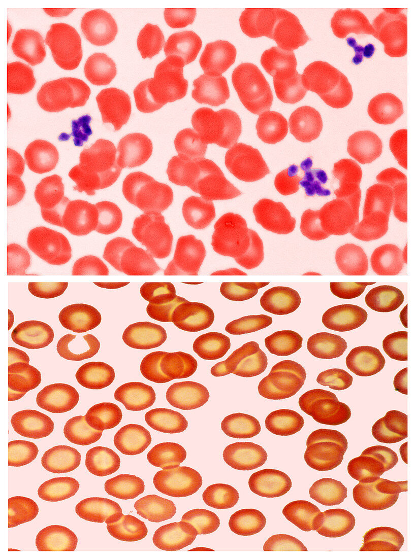 Normal and Iron-Deficient Blood Cells