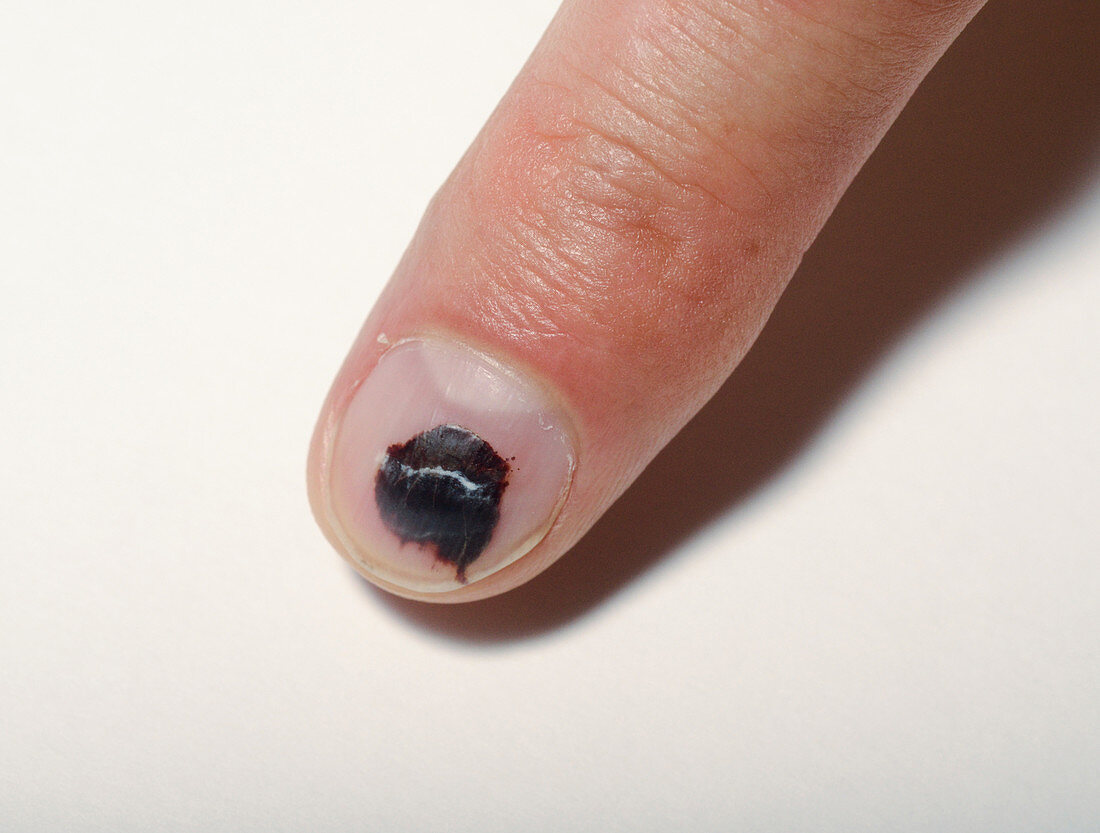Bruised finger