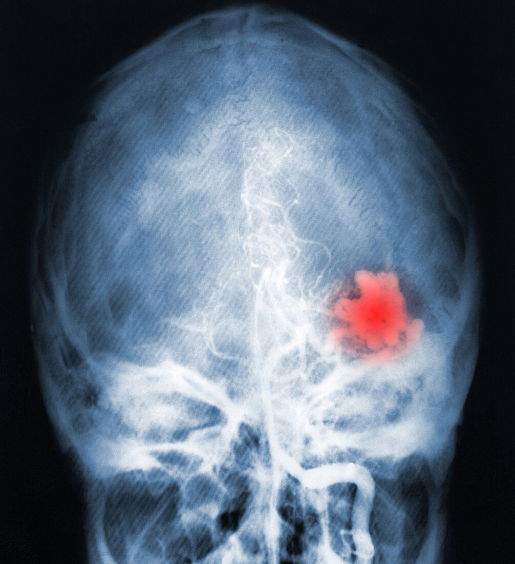 Cerebellar Angioma X-Ray