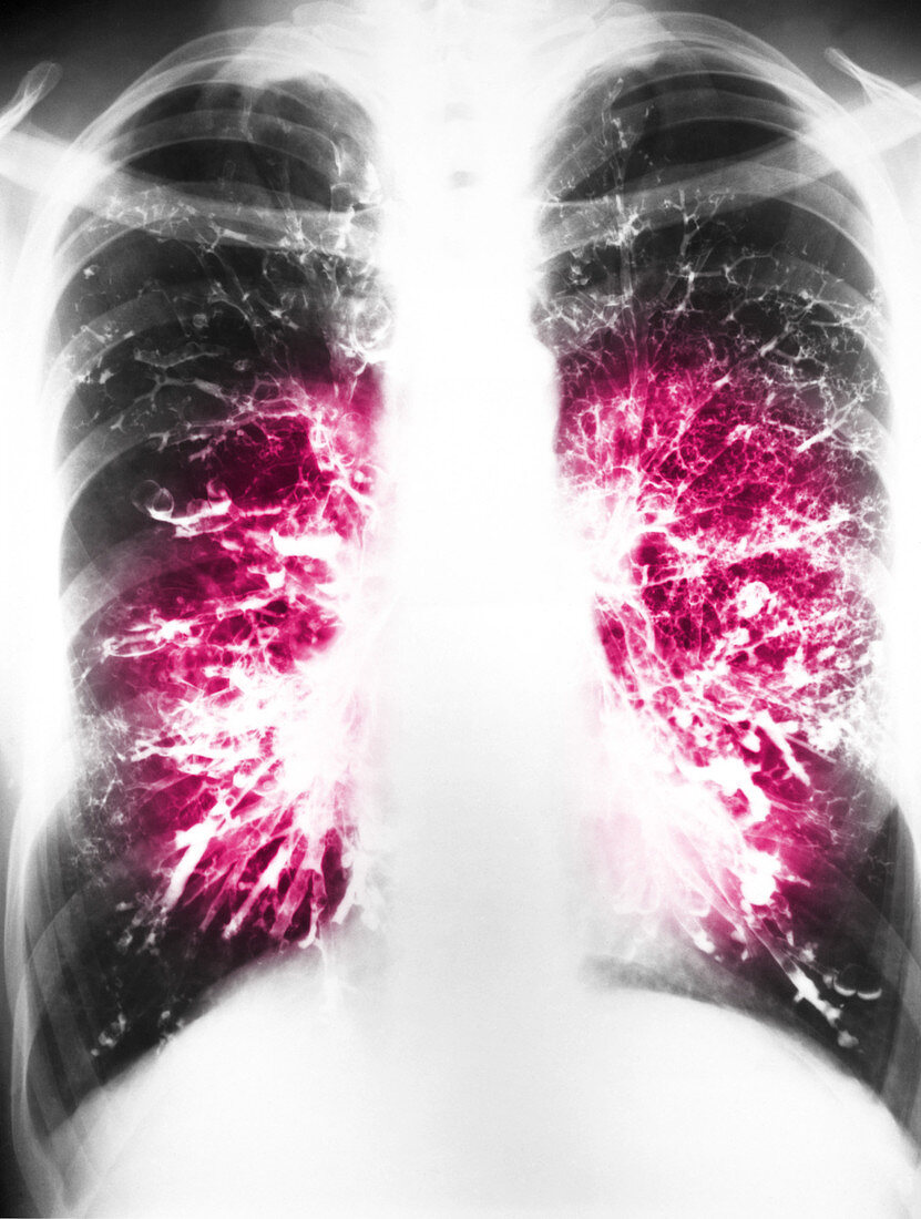Bronchiectasis X-Ray