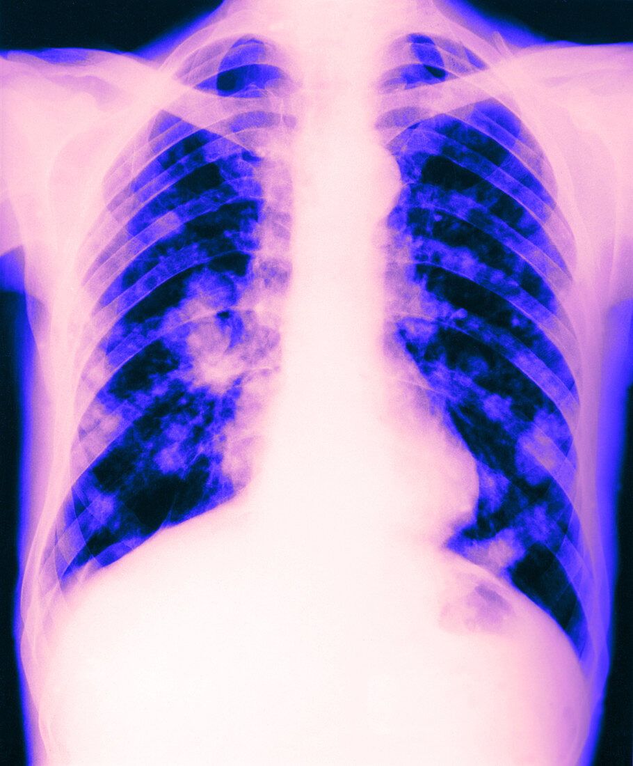 Tuberculosis of the Lung
