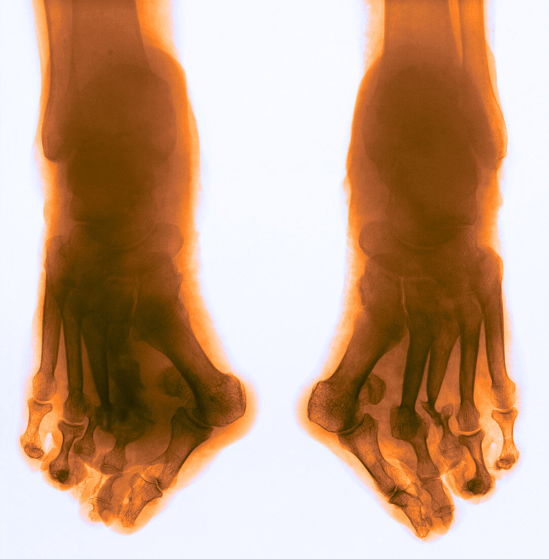 Charcot foot,X-ray
