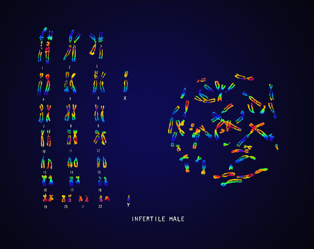 Infertile Male Karyotype