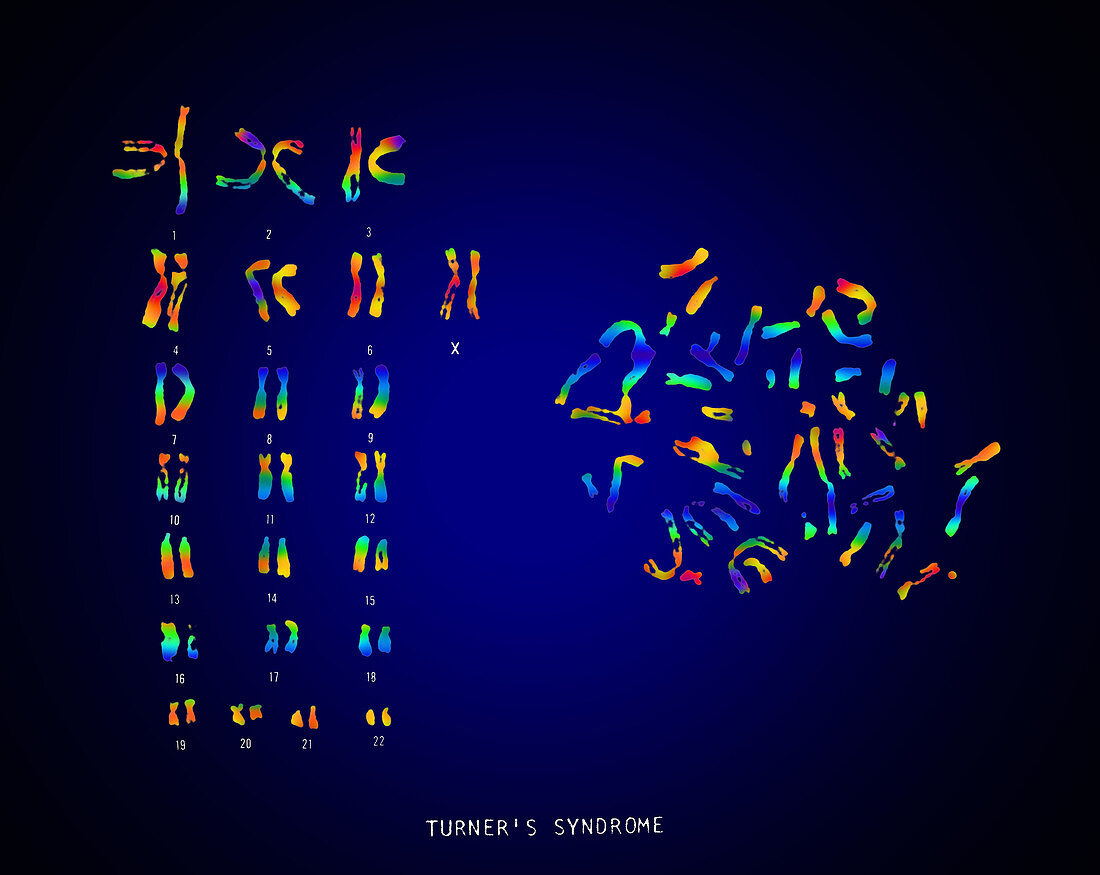 Turner's Syndrome Karyotype