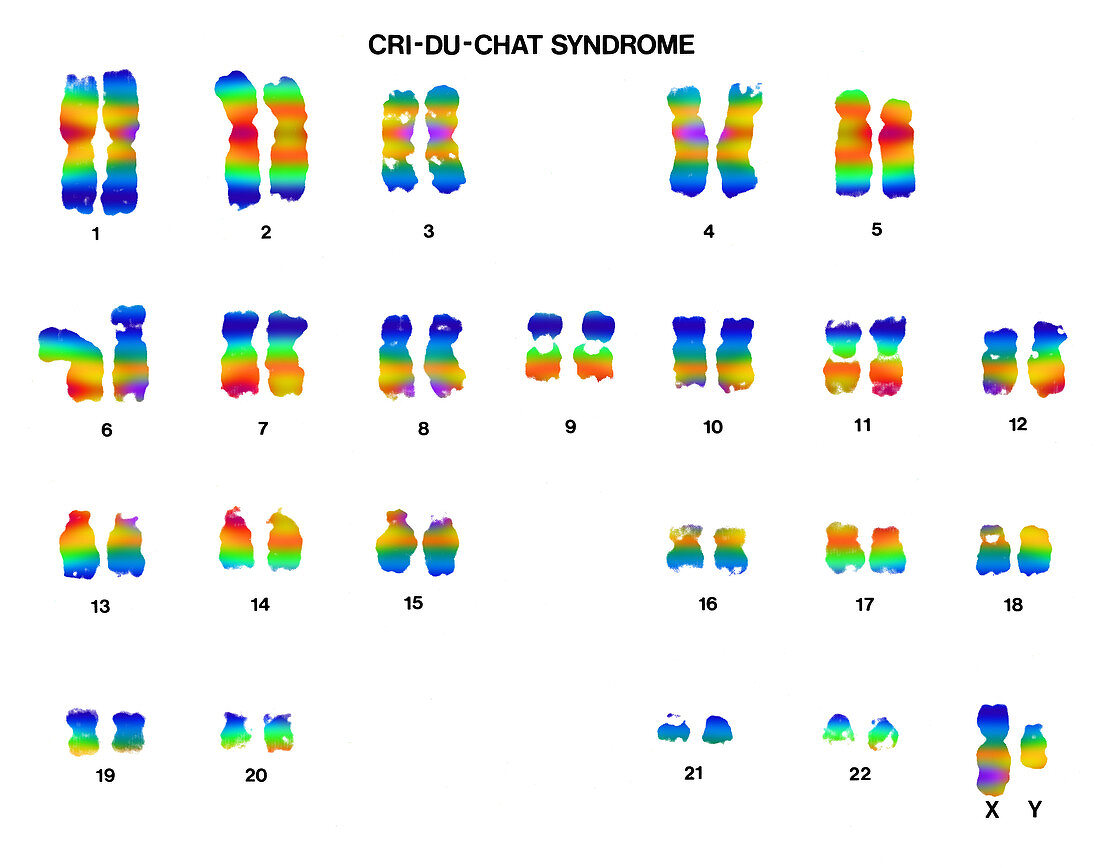 Cri du chat syndrome karyotype