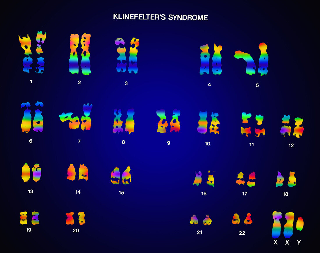 Klinefelter's Syndrome,Karyotype