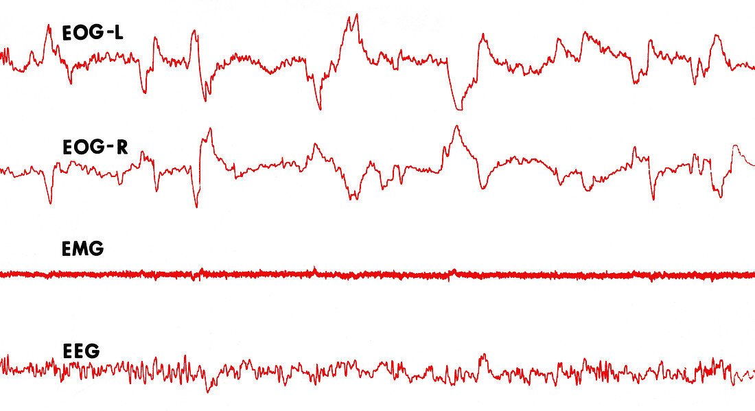 Polygraph Tracings of REM Sleep