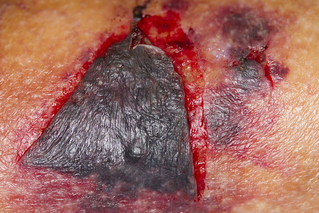 Traumatic Leg Wound