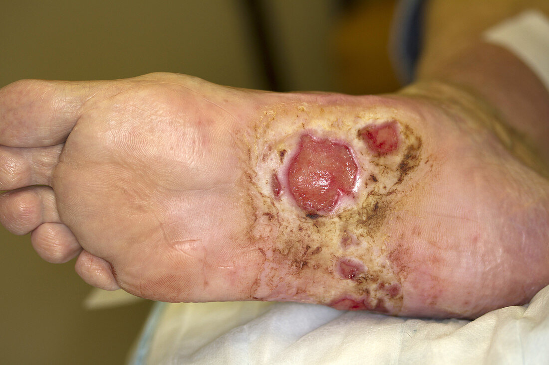 Diabetic foot Ulcer