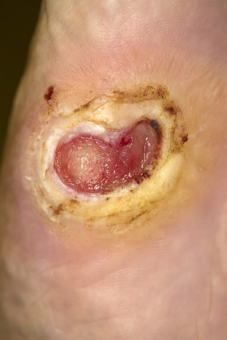 Diabetic foot Ulcer
