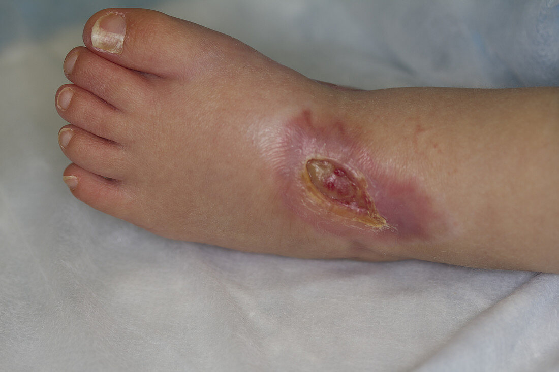 Foot Wound On Child