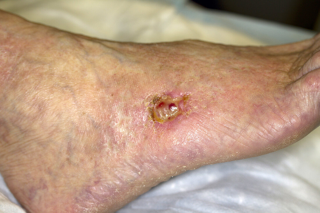 Chronic Peripheral Venous Insufficiency