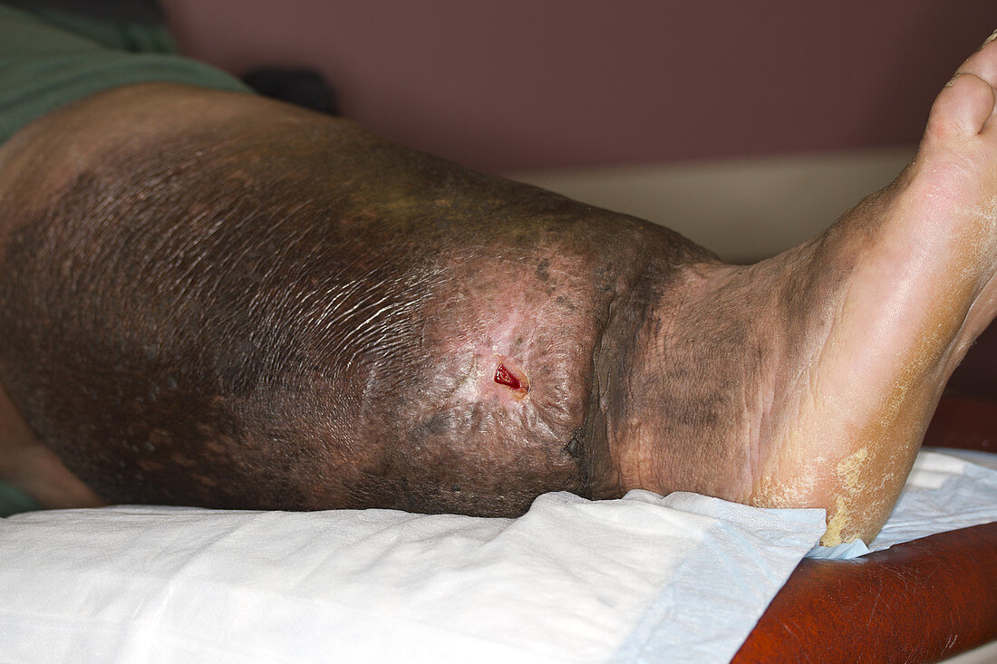 Chronic wound with lymphedema