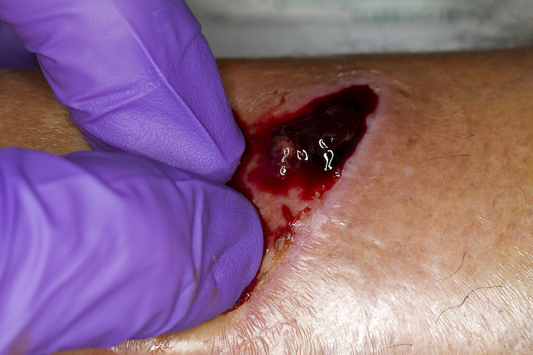 Leg Abscess