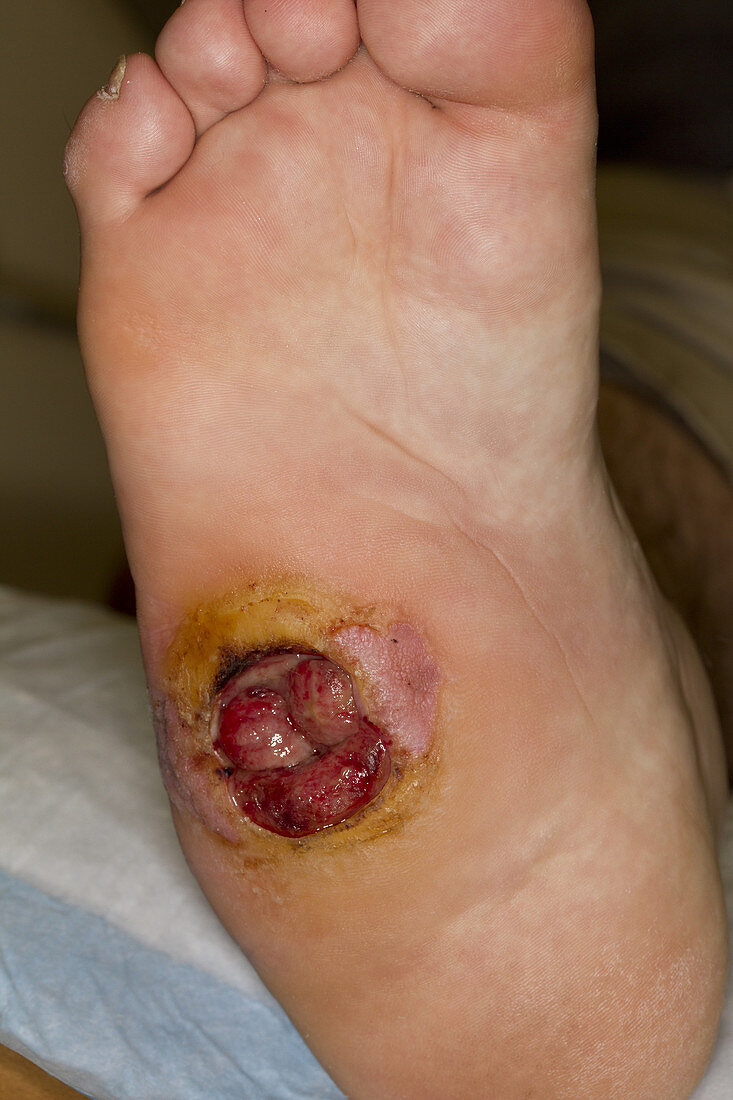 Foot Pressure Ulcer Stage III