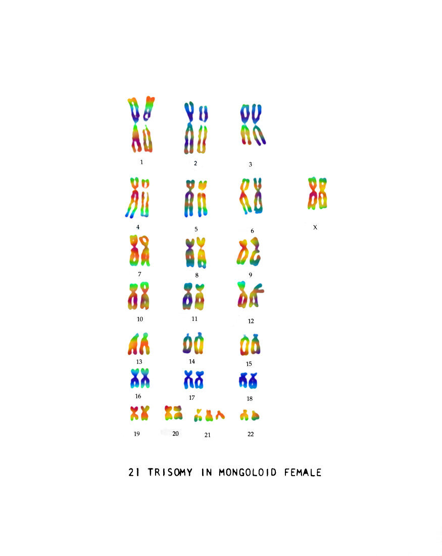 Female Karyotype showing Down's Syndrome