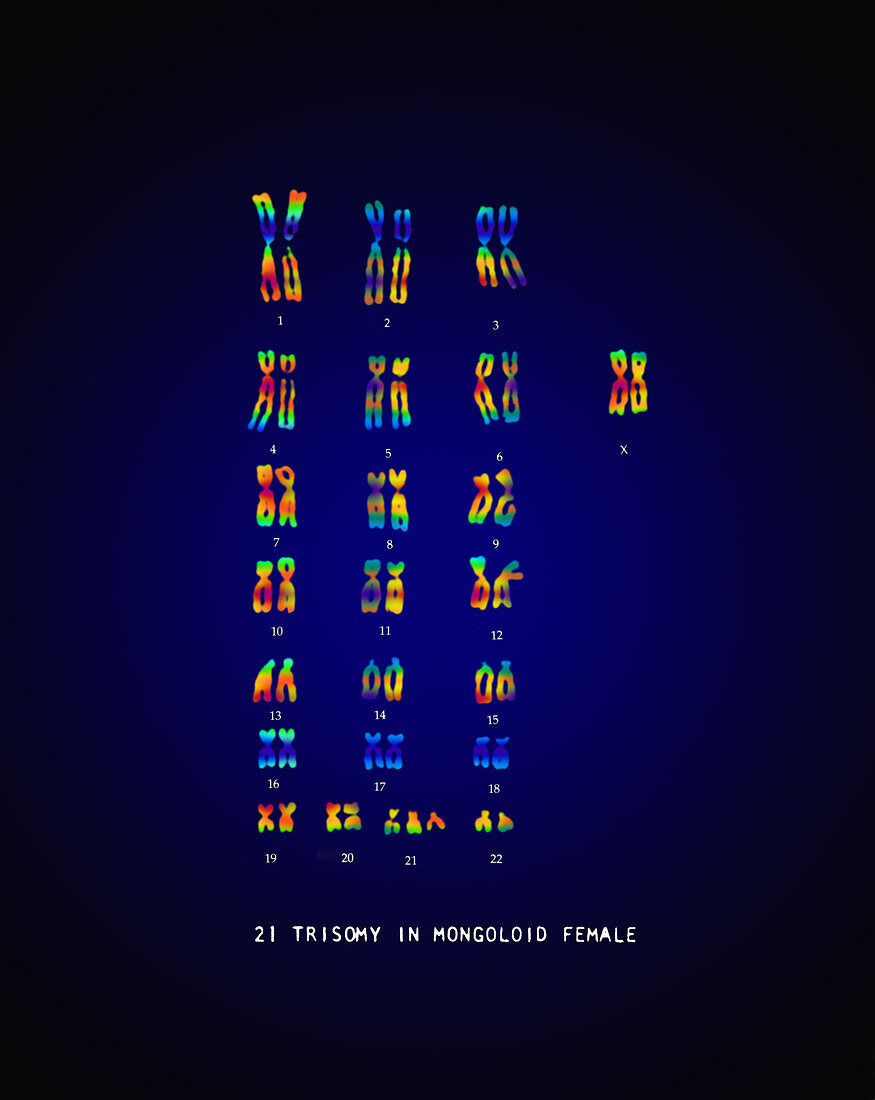 Female Karyotype showing Down's Syndrome