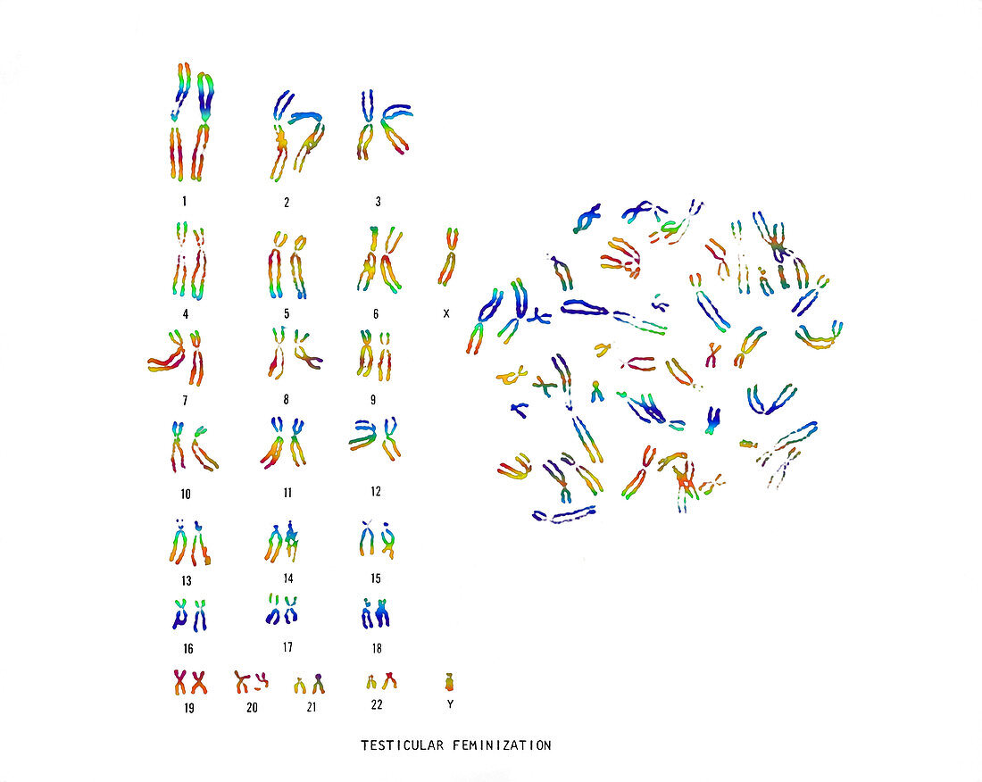 Testicular Feminization Karyotype