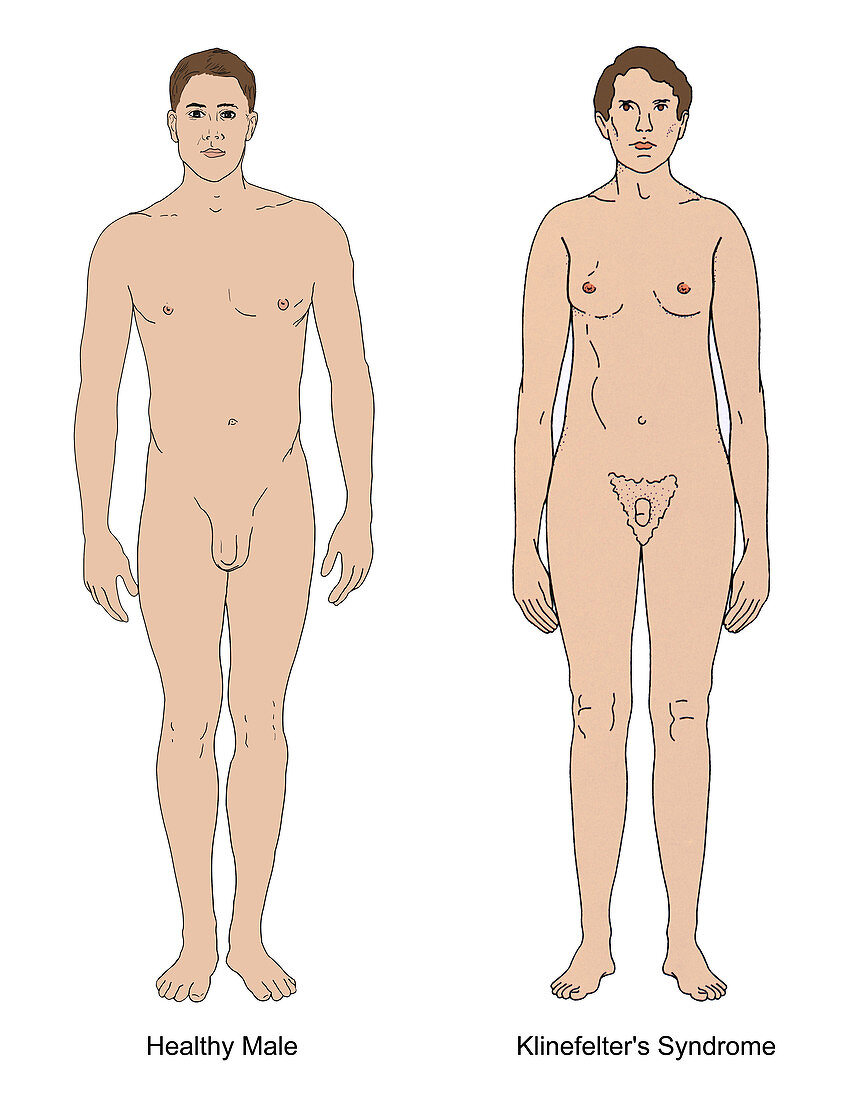 Klinefelter's Syndrome and Healthy Male