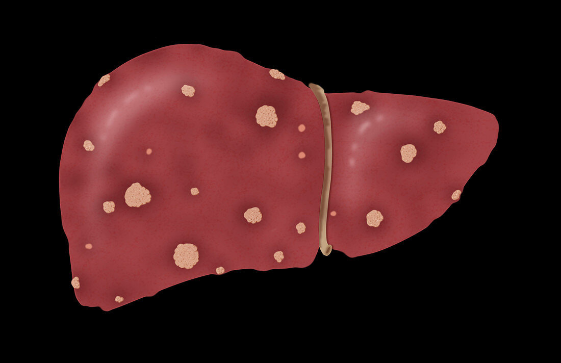 Liver Stage 2 Cirrhosis