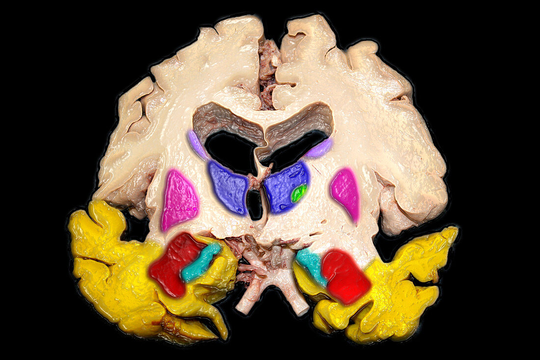 Colour Enhanced Severe Alzheimer's Diseas