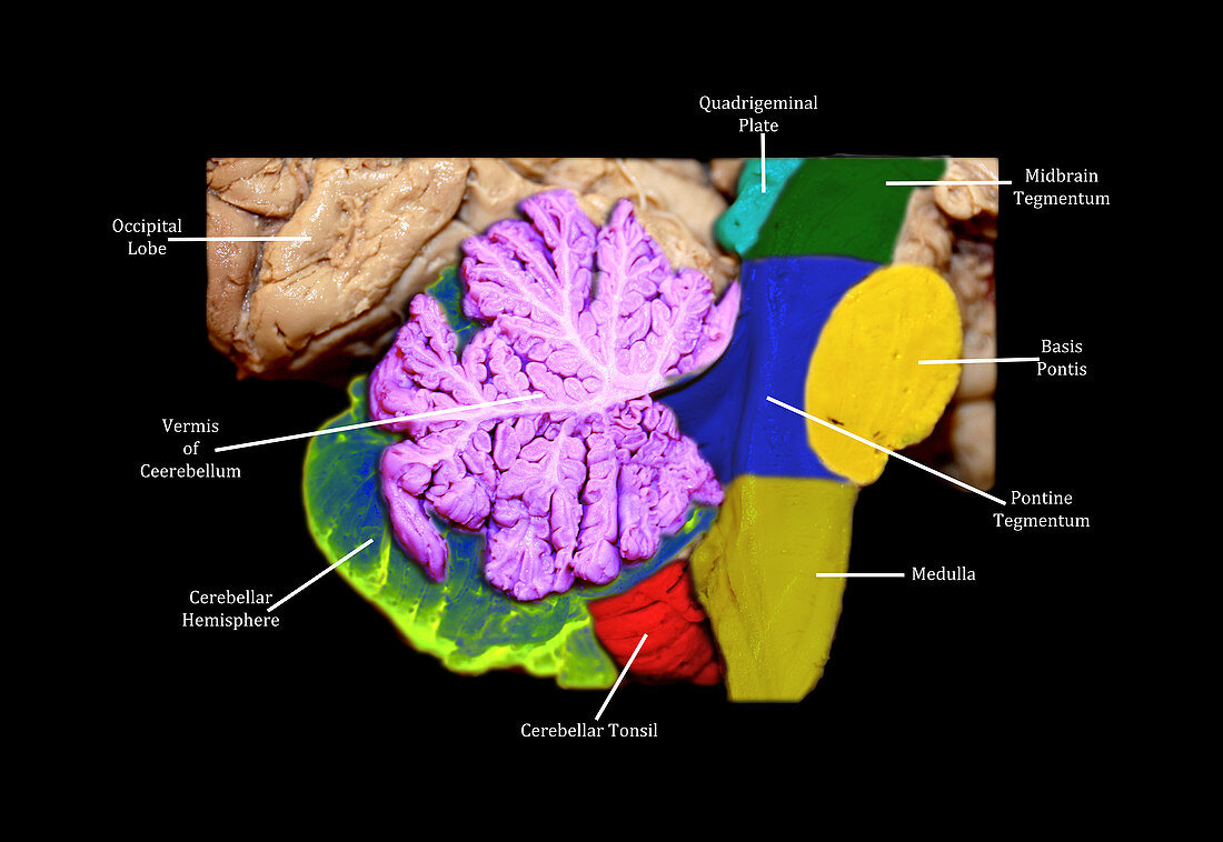 Brainstem,Cerebellum and Occipital Lobe