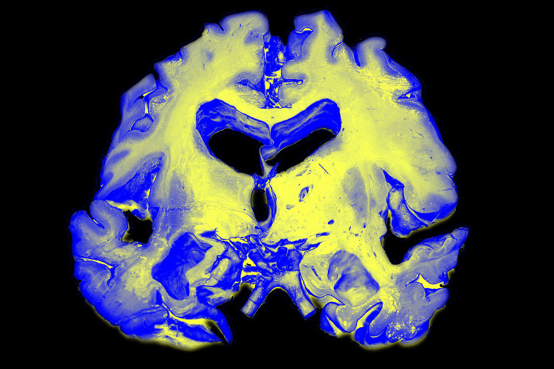 Brain with Severe Alzheimers Disease