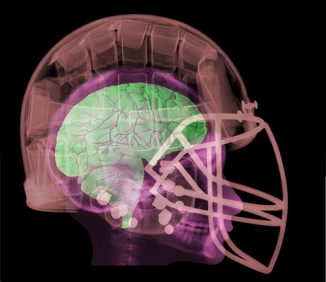X-ray of Head in Football Helmet