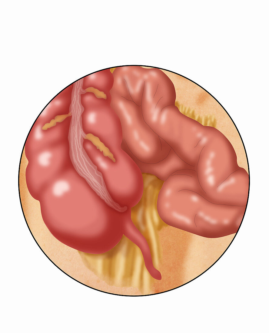 Normal Appendix