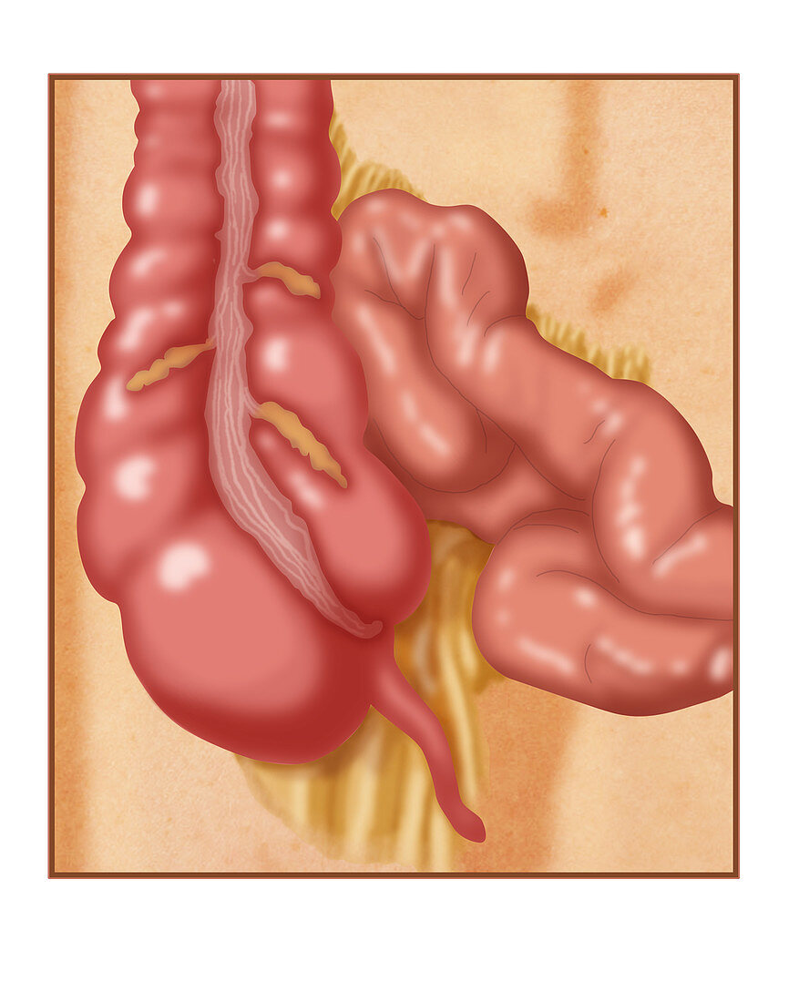 Normal Appendix