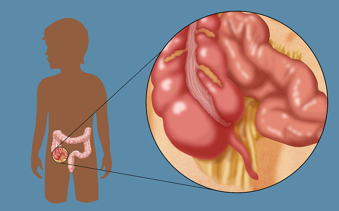 Normal Appendix