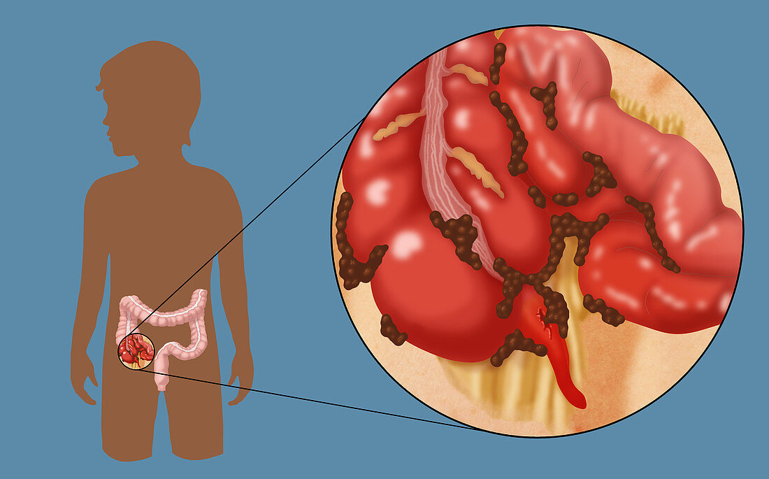 Ruptured Appendix