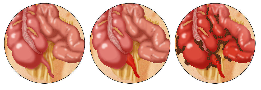 Appendicitis