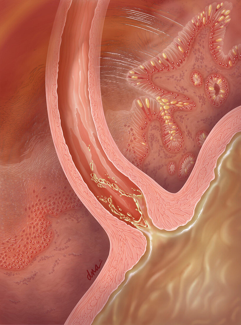 Gastroesophageal Reflux