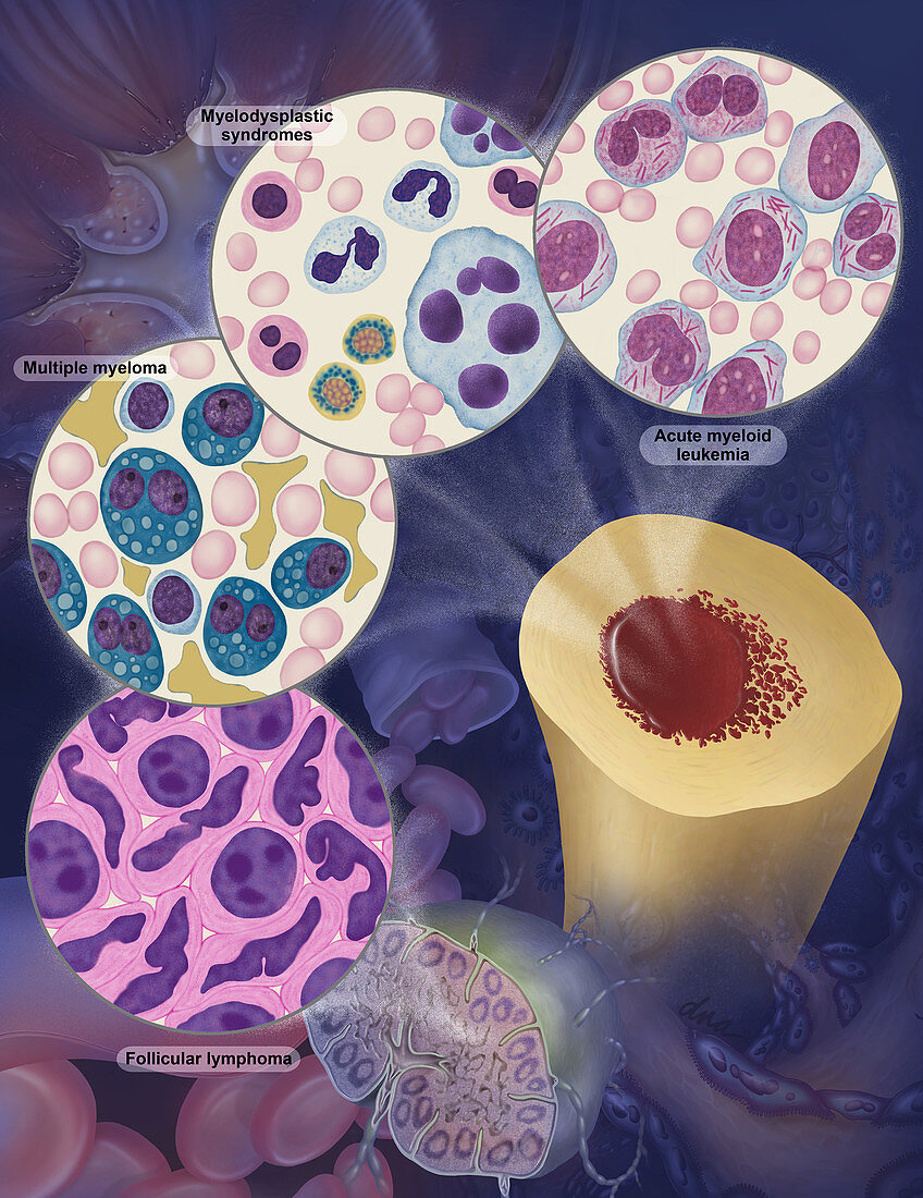 Hematological and Follicular Malignancies