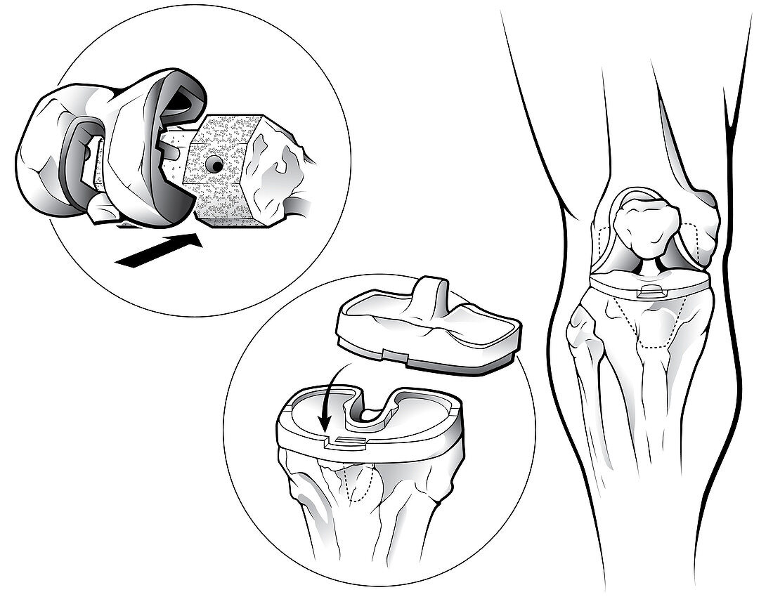 Total Knee Replacement (Prosthetic)