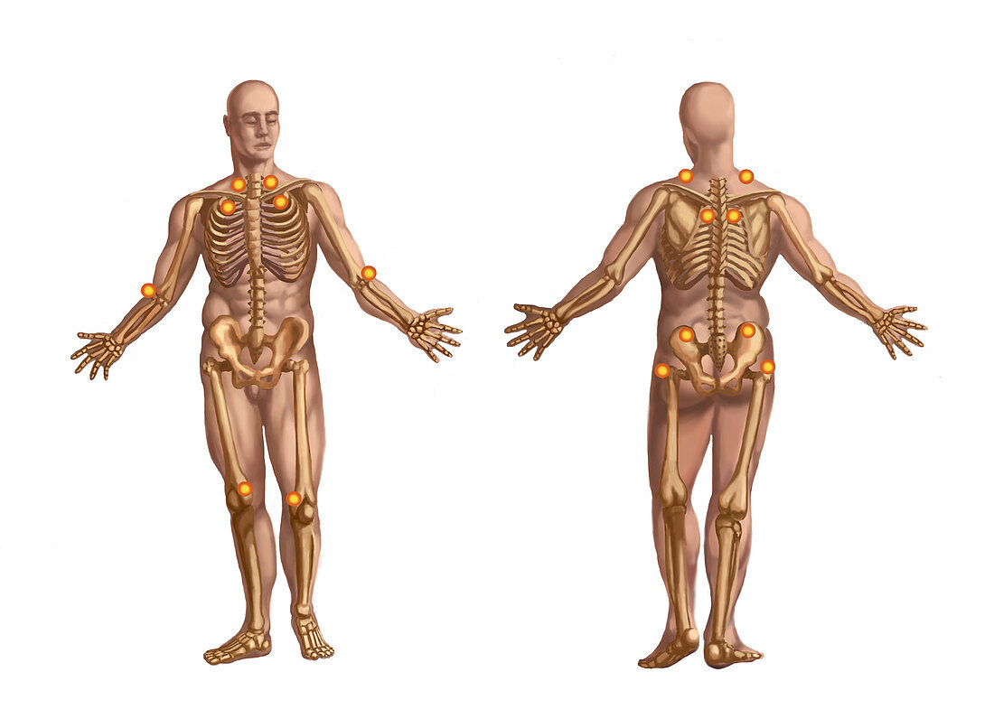 Trigger Points on the Human Body