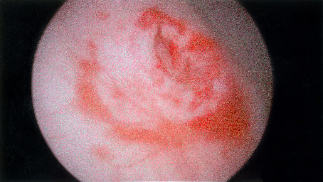 Surgical Repair of Ureterocele