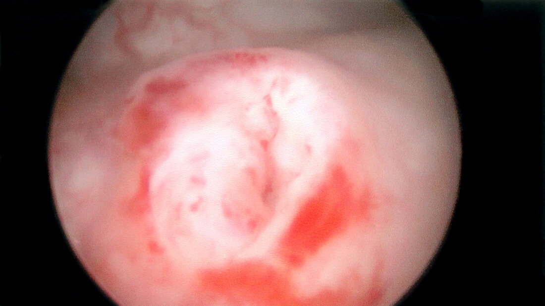 Surgical Repair of Ureterocele