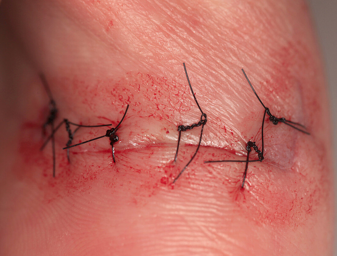 Wound Healing (1 of 4)