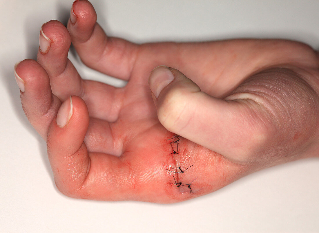 Stitches on Hand Wound