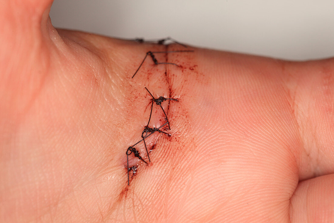 Wound Healing (Day 4)