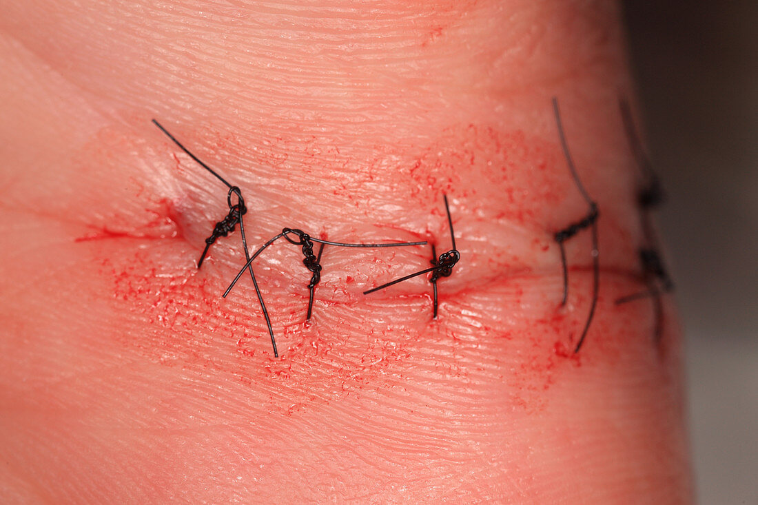 Wound Healing (Day 1)