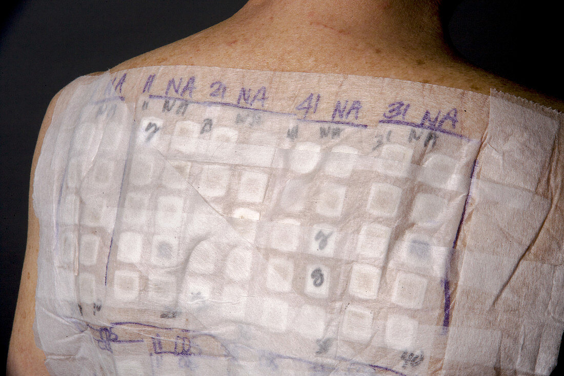 Allergy Patch Test