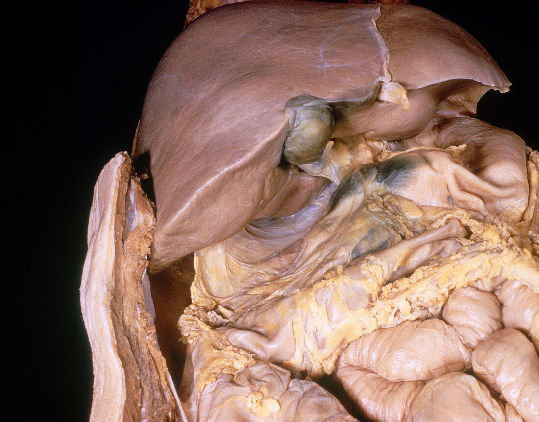 Liver,Gallbladder,and Stomach