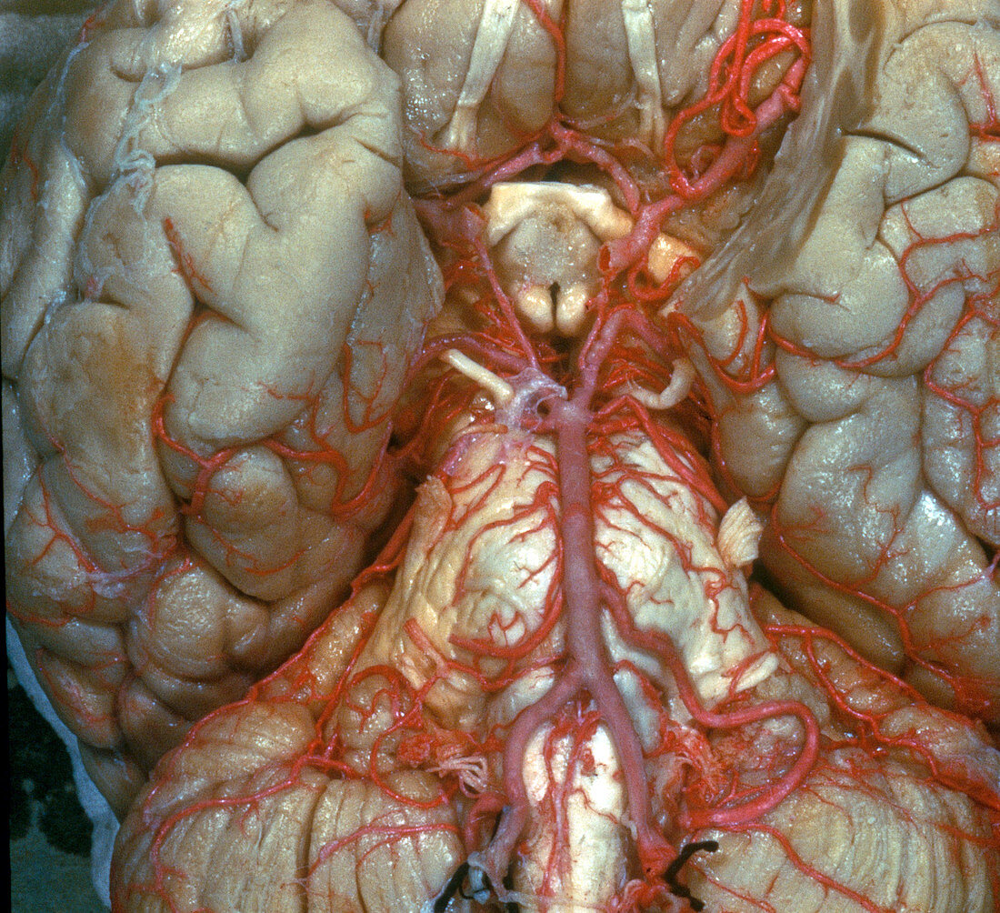 Arteries at Base of Brain