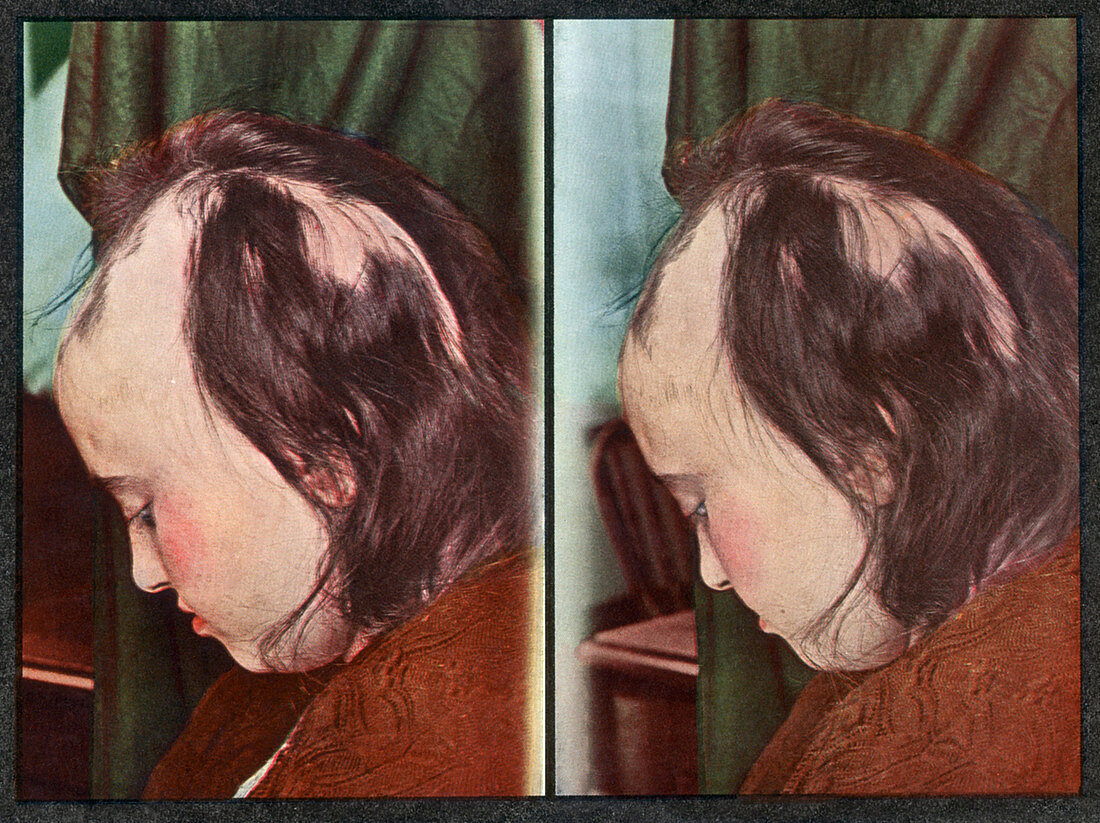 Alopecia areata,Stereoscopic Image